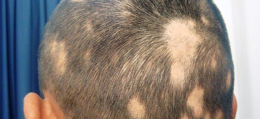 Вогнищева алопеція: прояви та рішення проблеми випадіння волосся